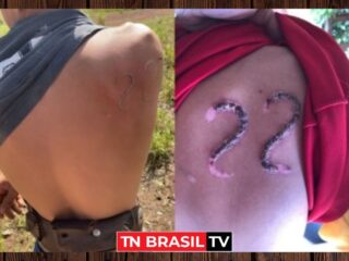 Com ferro em brasa adolescente marca o corpo com o 22 de Jair Bolsonaro na pele