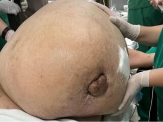 Médicos retiram tumor de 46 Kg de mulher no Rio de Janeiro