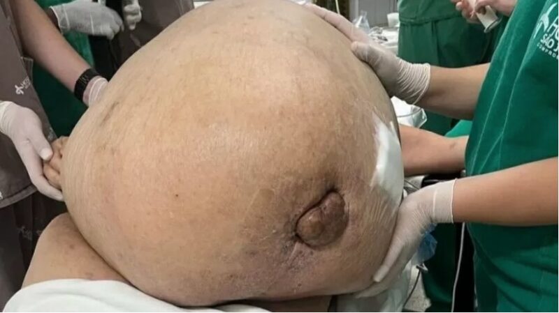 Médicos retiram tumor de 46 Kg de mulher no Rio de Janeiro