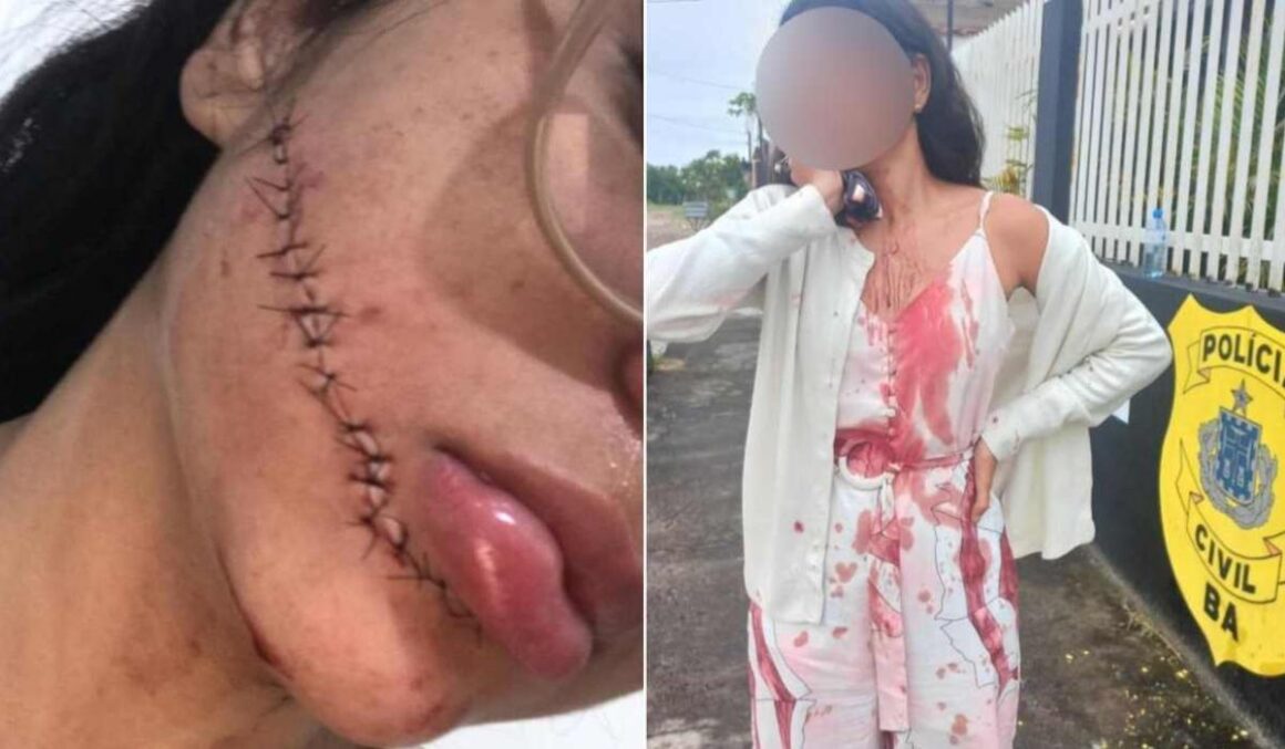 Mulher leva facada no rosto enquanto dormia em viagem de ônibus para Salvador