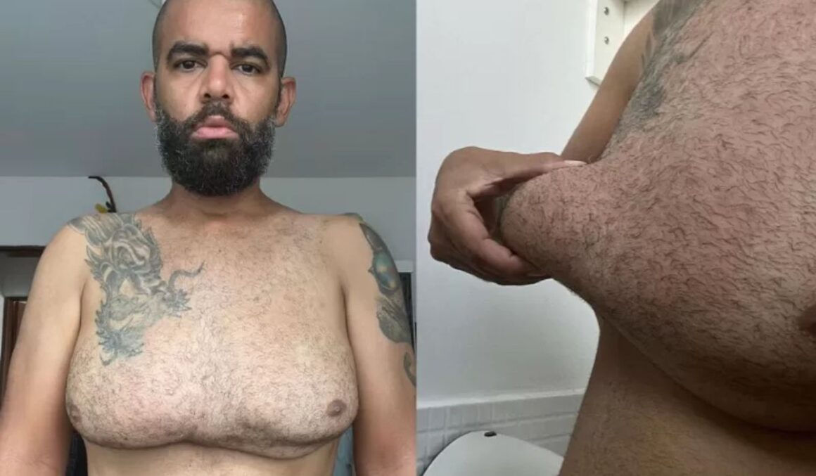 'Queria ter corpo de academia rápido, injetei gel em casa e vivo pesadelo'