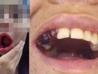Governador Helder Barbalho afasta médico que extraiu 17 dentes de jovem autista