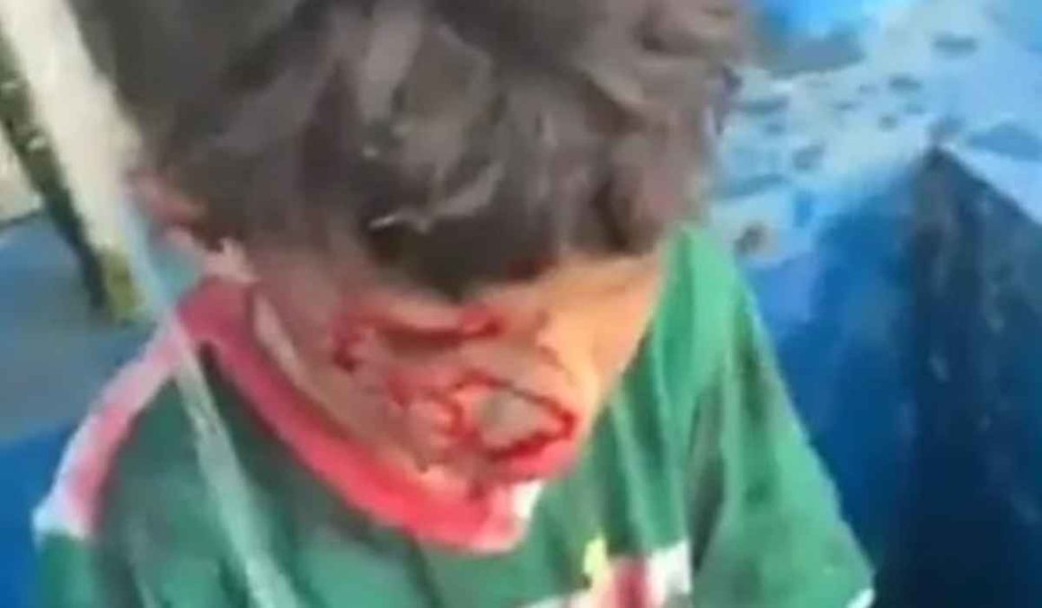 IMAGENS FORTES: Criança é atacada por porco do mato e fica gravemente ferida